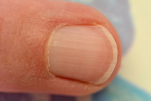 How to Strengthen Brittle & Splitting Nails Naturally with Vitamin E Oil